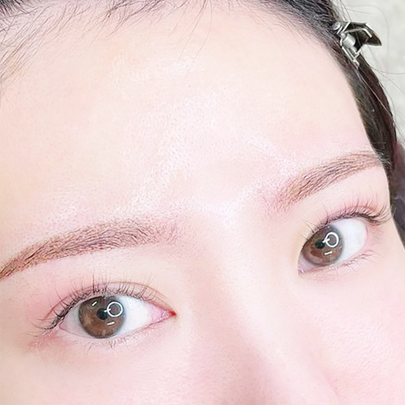 BROW（眉）への施術の一例 2D