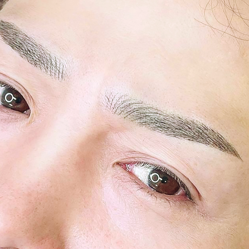 BROW（眉）への施術の一例 4D