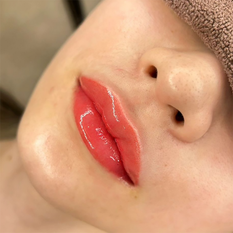 LIP（唇）への施術の一例
